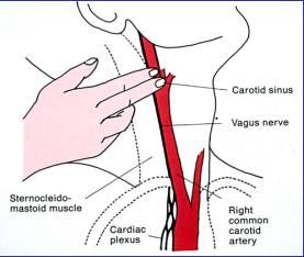 carotid-sinus